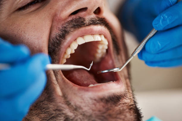 Best Emergency Wisdom Teeth Removal in Bradford, PA